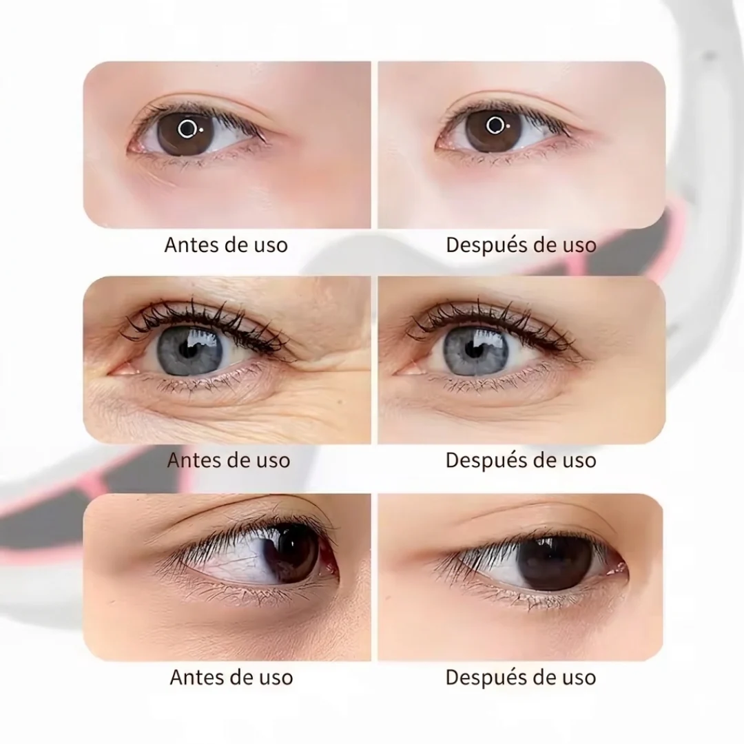 Eye Releaf | Gafas Terapeuticas